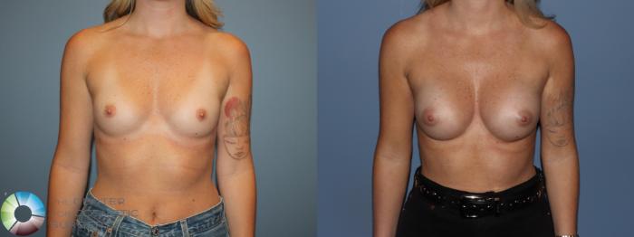 Before & After Small Implant Breast Augmentation (Breast Preservation) Case 12176 Front in Denver and Colorado Springs, CO