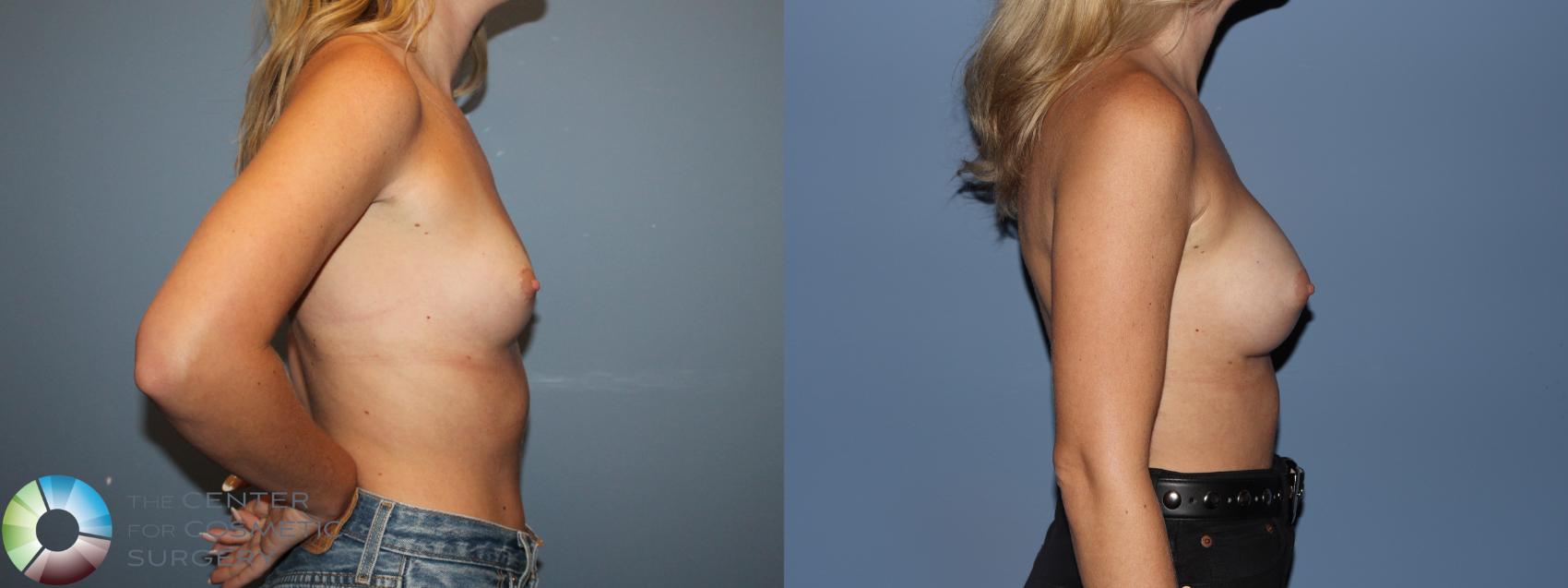 Before & After Motiva Implants® Case 12176 Left Side in Denver and Colorado Springs, CO