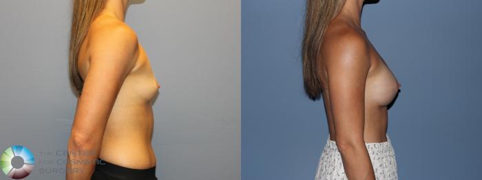 Before & After Small Implant Breast Augmentation (Breast Preservation) Case 12177 Left Side in Denver and Colorado Springs, CO