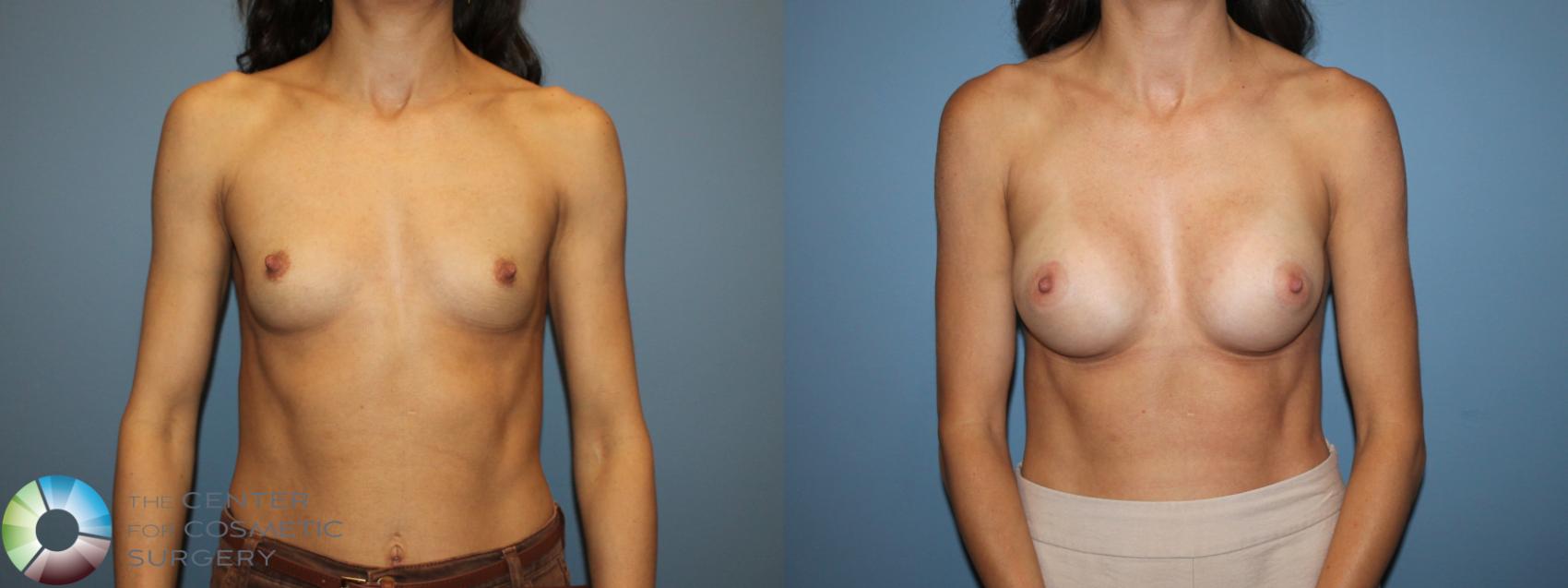 Before & After Small Implant Breast Augmentation (Breast Preservation) Case 12178 Front in Denver and Colorado Springs, CO