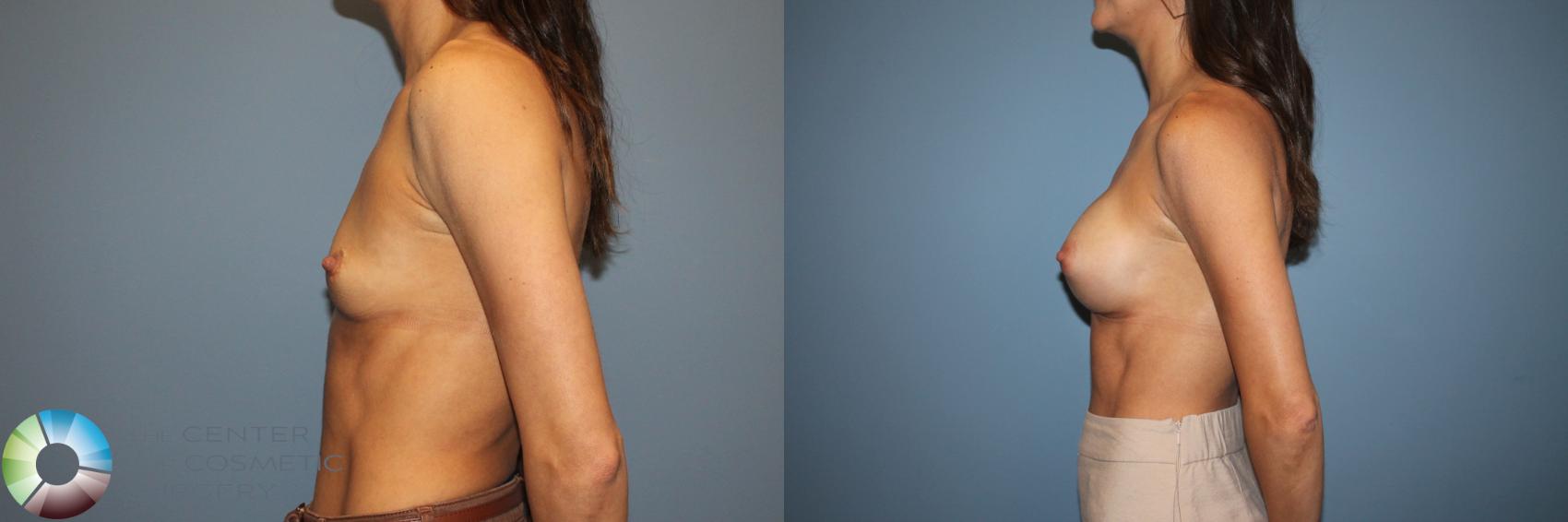 Before & After Motiva Implants® Case 12178 Left Side in Denver and Colorado Springs, CO