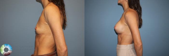 Before & After Small Implant Breast Augmentation (Breast Preservation) Case 12178 Left Side in Denver and Colorado Springs, CO