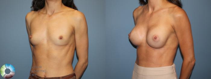 Before & After Small Implant Breast Augmentation (Breast Preservation) Case 12178 Right Oblique in Denver and Colorado Springs, CO