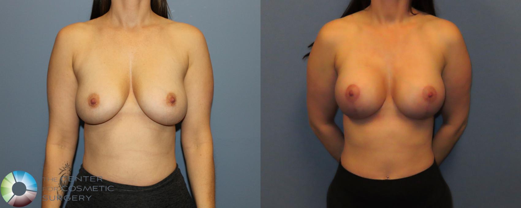Before & After Motiva Implants® Case 12179 Front in Denver and Colorado Springs, CO
