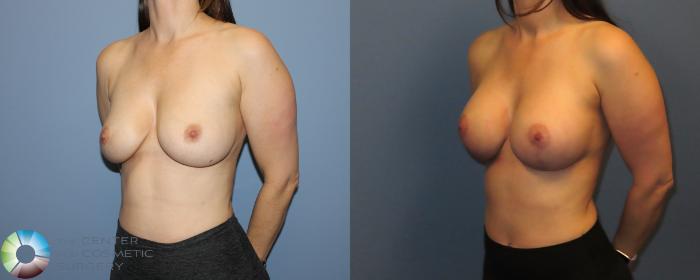 Before & After Motiva Implants® Case 12179 Right Oblique in Denver and Colorado Springs, CO