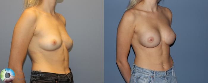 Before & After Motiva Implants® Case 12180 Right Oblique in Denver and Colorado Springs, CO