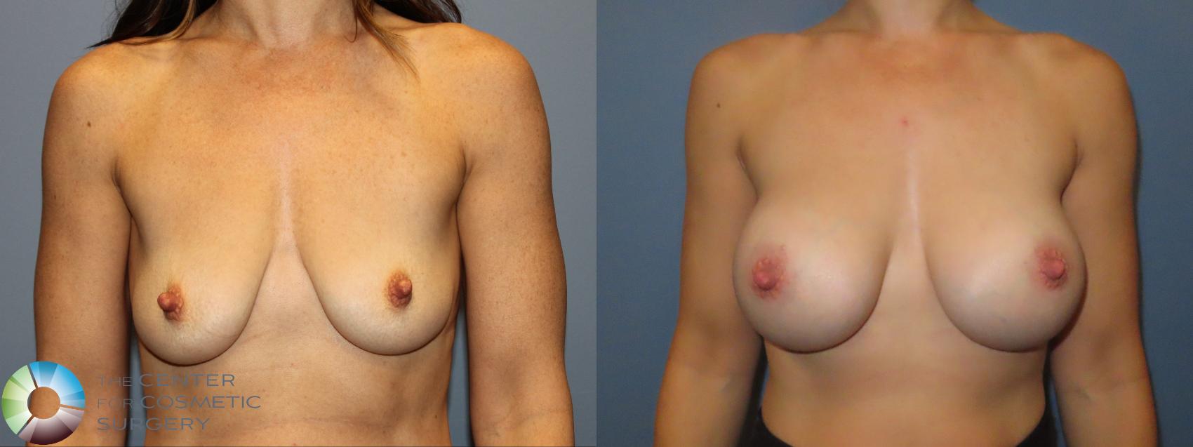 Best Denver Breast Augmentation Motiva
