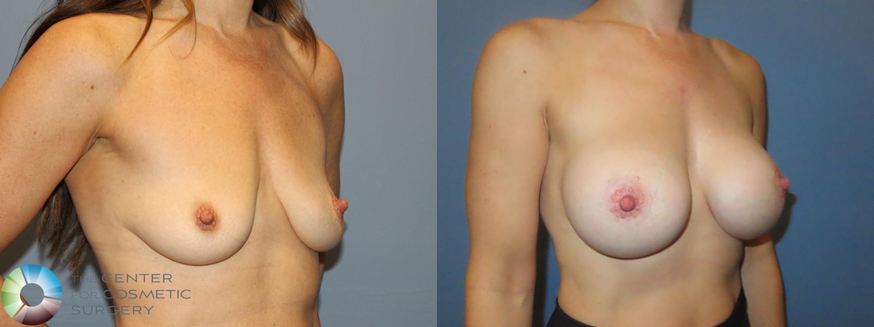 Before & After Motiva Implants® Case 12215 Right Oblique in Denver and Colorado Springs, CO