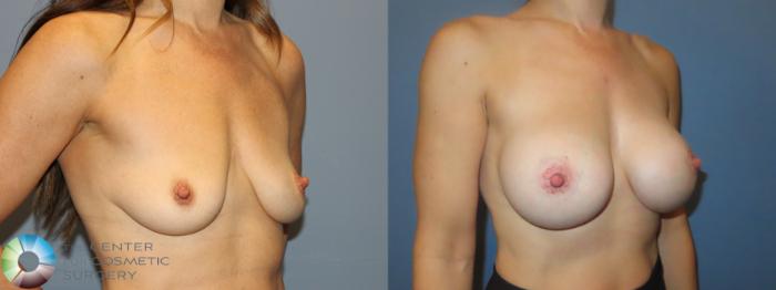 Best Denver Breast Augmentation/Implants Motiva
