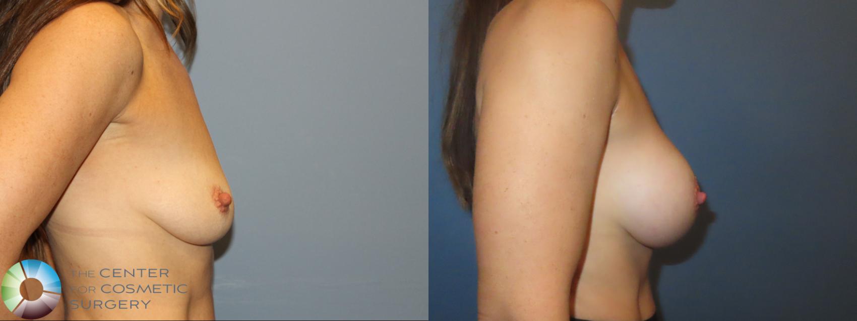 Before & After Motiva Implants® Case 12215 Right Side in Denver and Colorado Springs, CO