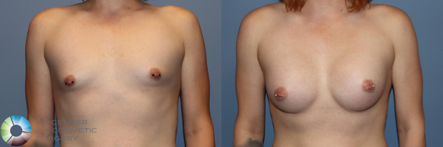 Before & After MTF Top Surgery/Breast Augmentation Case 11915 Front in Denver and Colorado Springs, CO