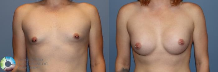 Before & After MTF Top Surgery/Breast Augmentation Case 11915 Front View in Golden, CO