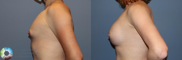 Before & After MTF Top Surgery/Breast Augmentation Case 11915 Right Side in Denver and Colorado Springs, CO
