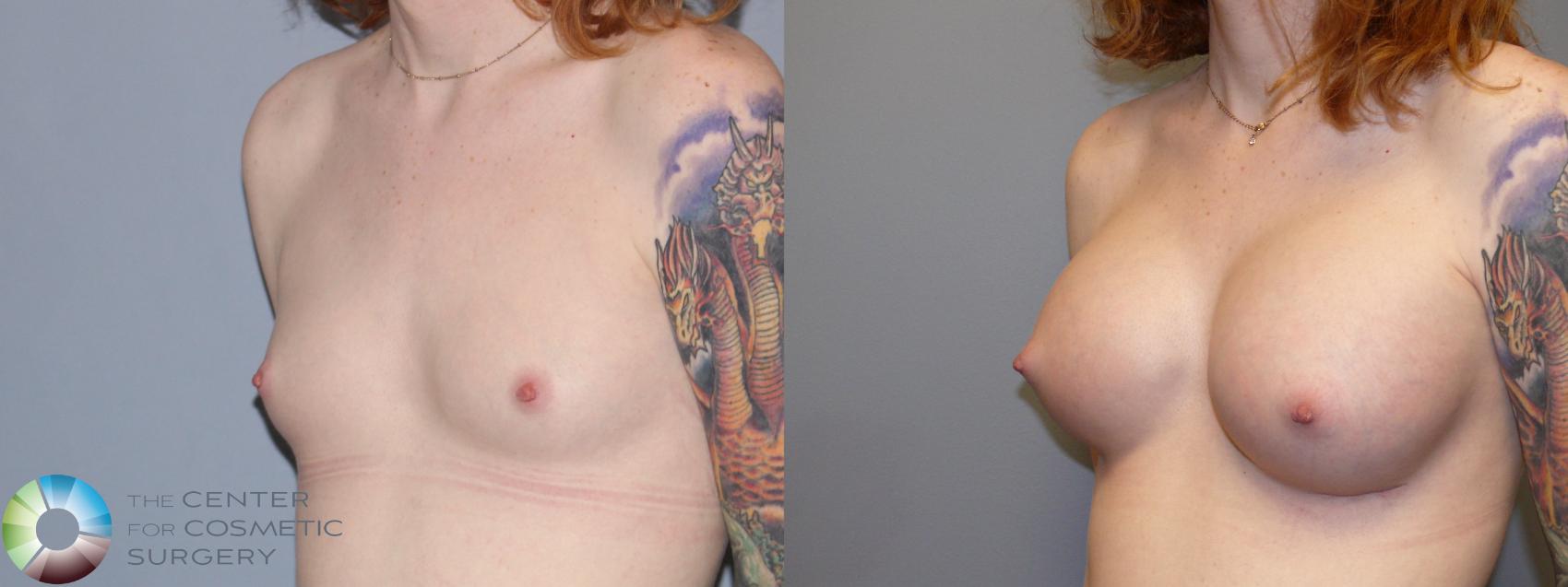 Before & After MTF Top Surgery/Breast Augmentation Case 11979 Left Oblique in Denver and Colorado Springs, CO