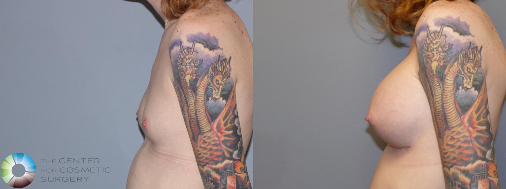 Before & After MTF Top Surgery/Breast Augmentation Case 11979 Left Side in Denver and Colorado Springs, CO