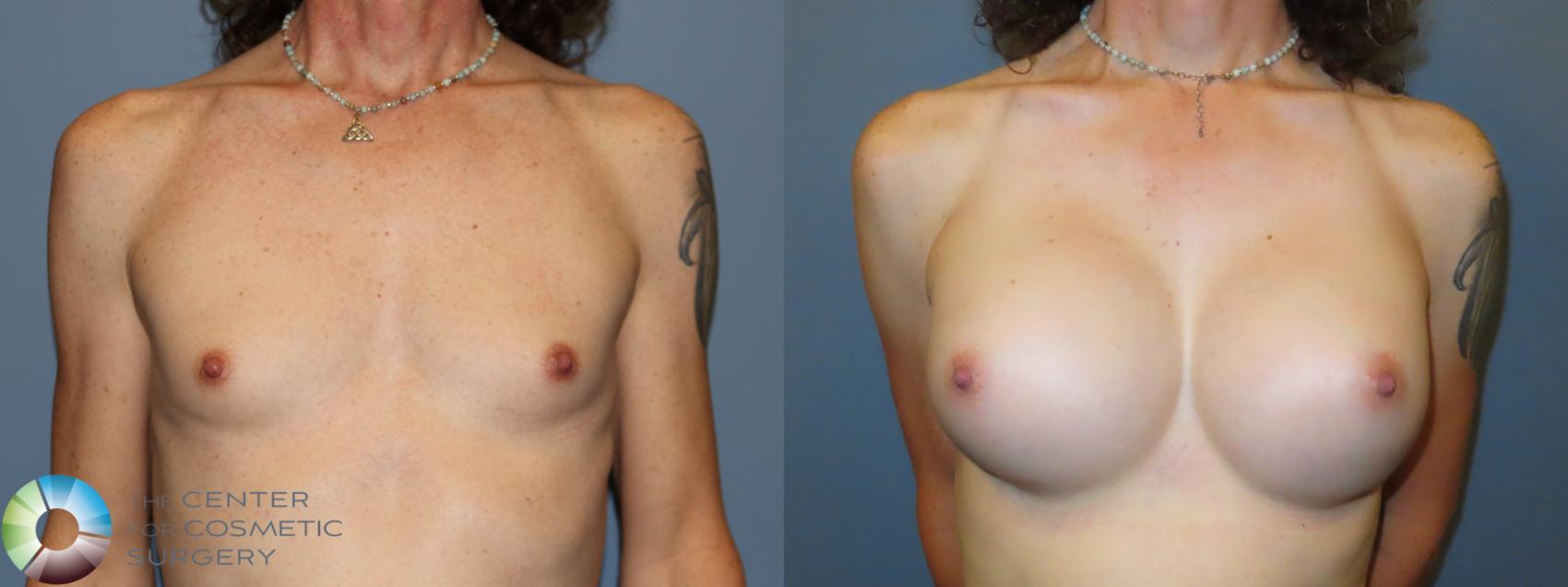 Before & After MTF Top Surgery/Breast Augmentation Case 11980 Front in Denver and Colorado Springs, CO