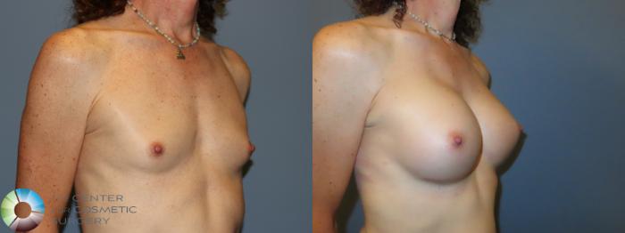 Best Denver MTF Breast Augmentation