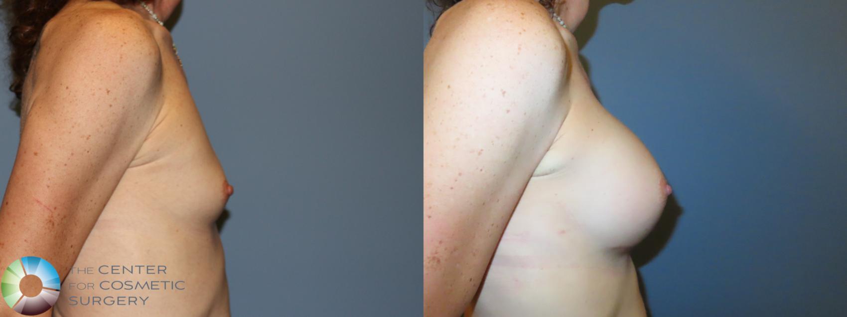Before & After MTF Top Surgery/Breast Augmentation Case 11980 Right Side in Denver and Colorado Springs, CO