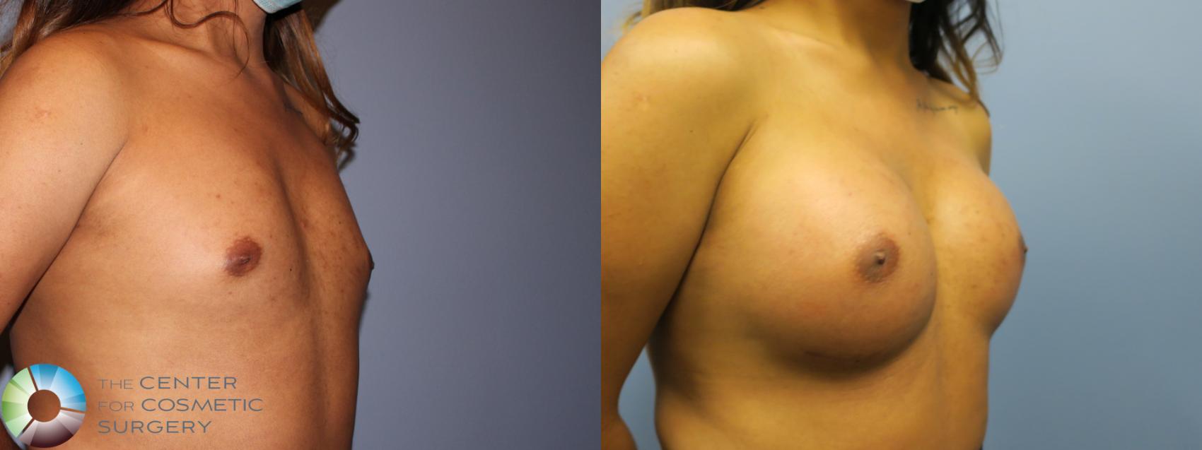 Before & After MTF Top Surgery/Breast Augmentation Case 11981 Right Oblique in Denver and Colorado Springs, CO