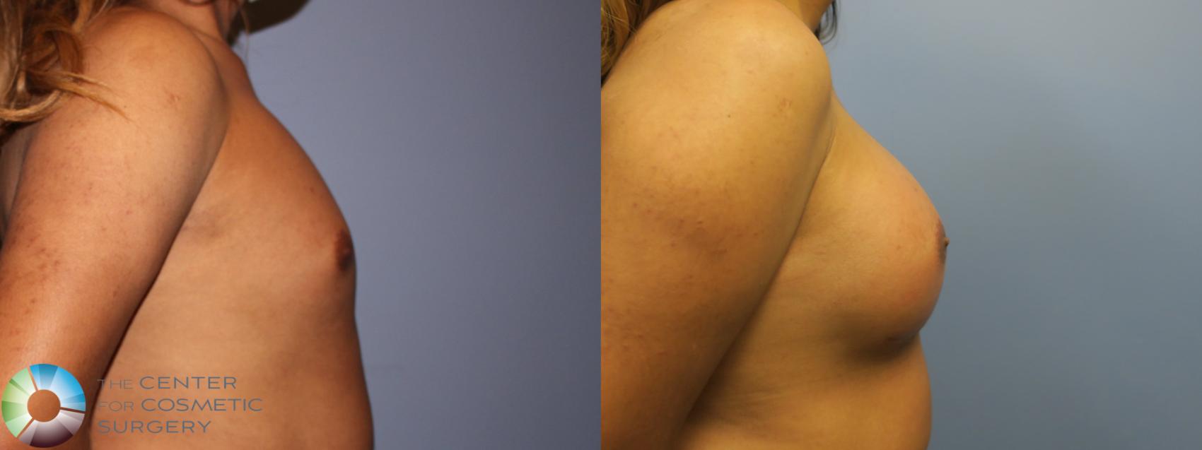 Before & After MTF Top Surgery/Breast Augmentation Case 11981 Right Side in Denver and Colorado Springs, CO
