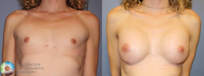 Best Denver MTF Breast Augmentation