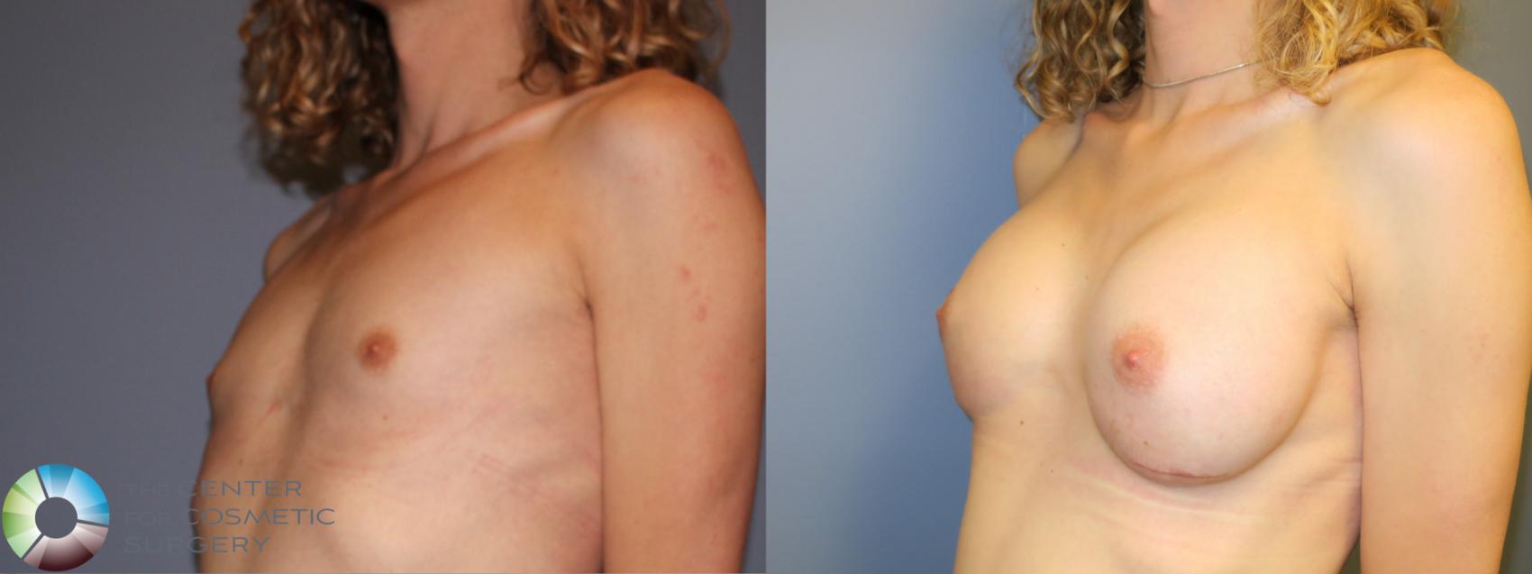 Before & After MTF Top Surgery/Breast Augmentation Case 11982 Left Oblique in Denver and Colorado Springs, CO