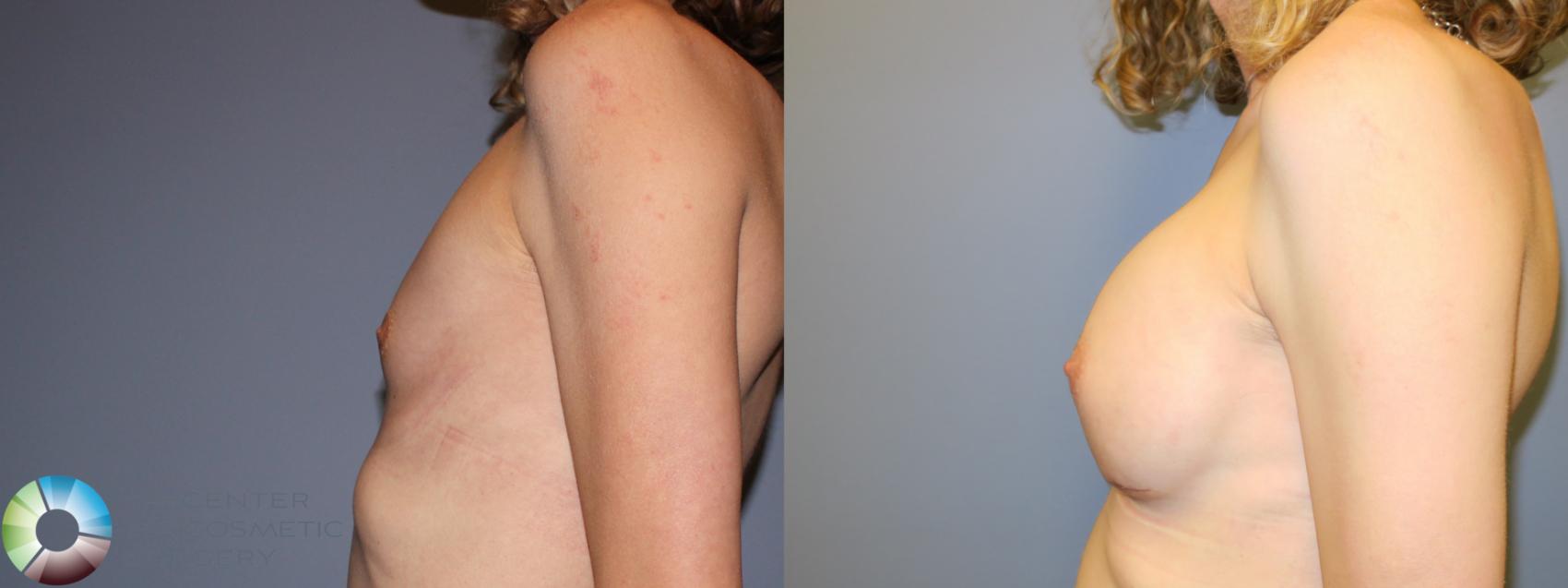 Before & After MTF Top Surgery/Breast Augmentation Case 11982 Left Side in Denver and Colorado Springs, CO