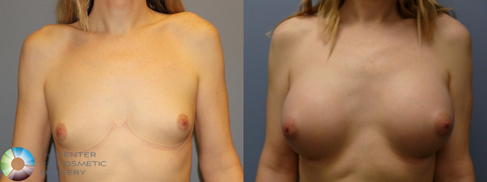 Before & After MTF Top Surgery/Breast Augmentation Case 11983 Front in Denver and Colorado Springs, CO