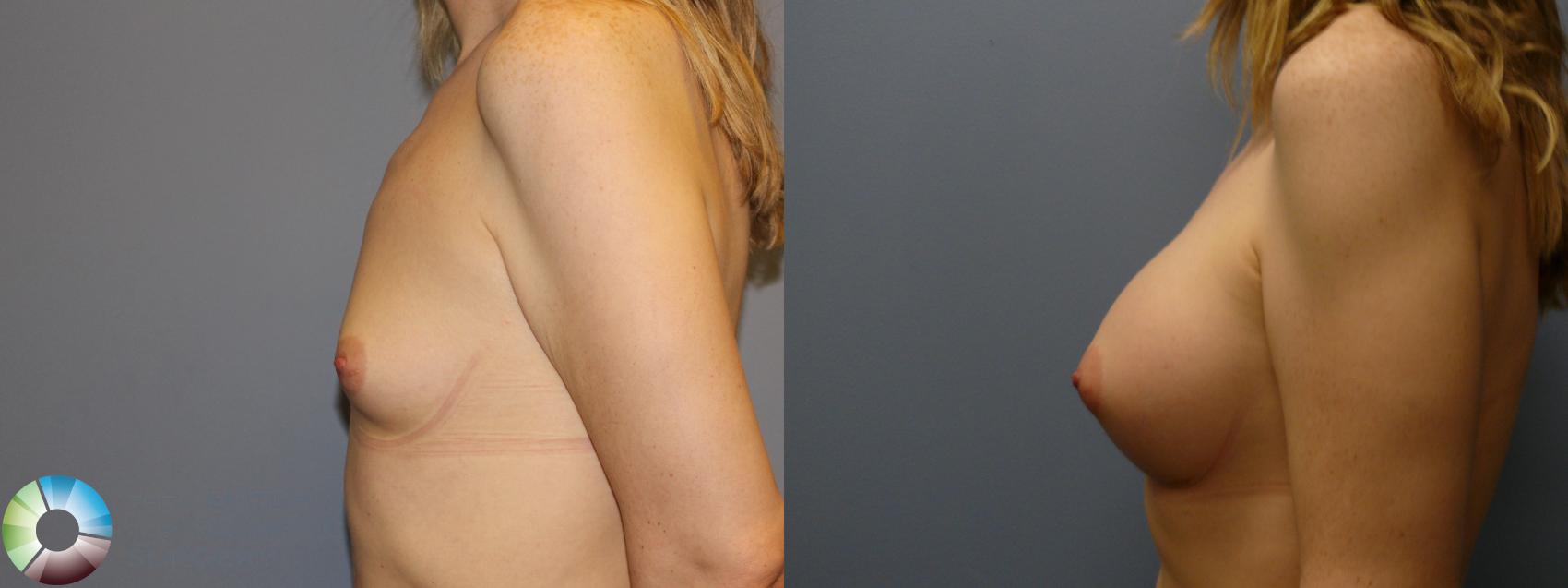 Before & After MTF Top Surgery/Breast Augmentation Case 11983 Left Side in Denver and Colorado Springs, CO