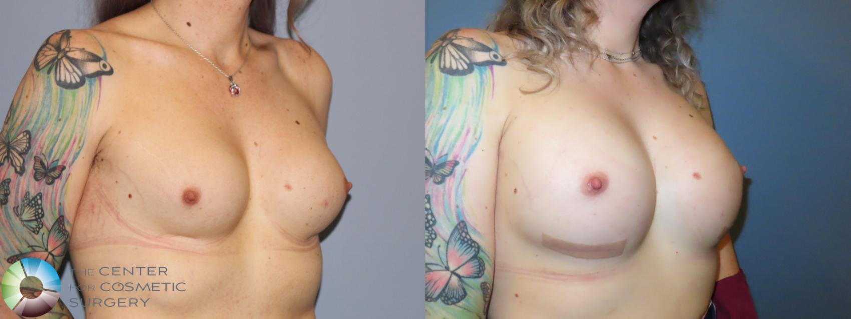 Before & After MTF Top Surgery/Breast Augmentation Case 11984 Right Oblique in Denver and Colorado Springs, CO