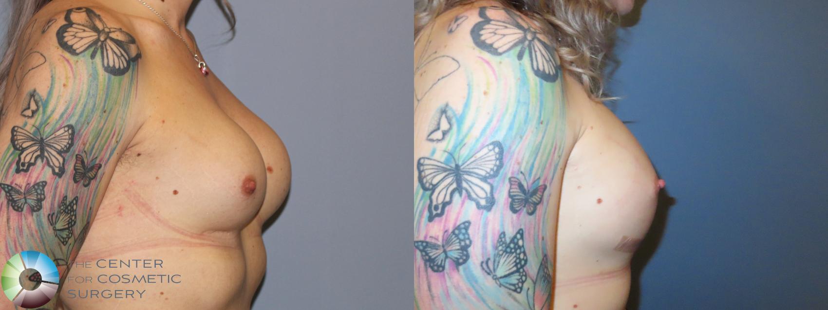 Before & After MTF Top Surgery/Breast Augmentation Case 11984 Right Side in Denver and Colorado Springs, CO