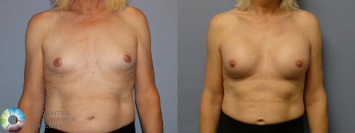 Before & After MTF Top Surgery/Breast Augmentation Case 12115 Front in Denver and Colorado Springs, CO