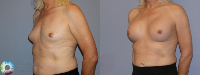 Before & After MTF Top Surgery/Breast Augmentation Case 12115 Left Oblique in Denver and Colorado Springs, CO