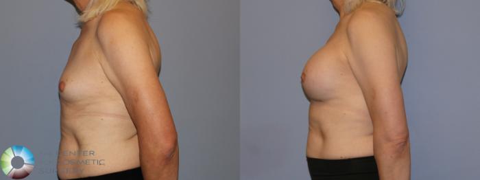 Before & After MTF Top Surgery/Breast Augmentation Case 12115 Left Side in Denver and Colorado Springs, CO