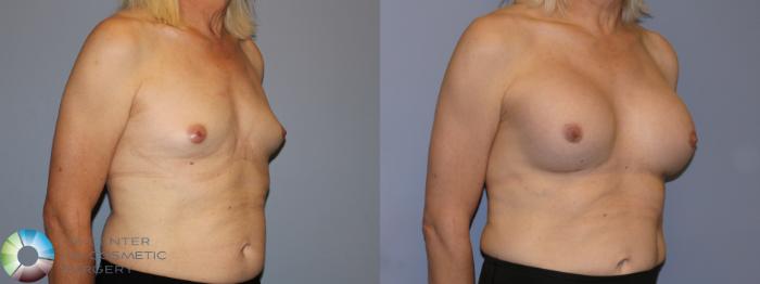 Before & After MTF Top Surgery/Breast Augmentation Case 12115 Right Oblique in Denver and Colorado Springs, CO