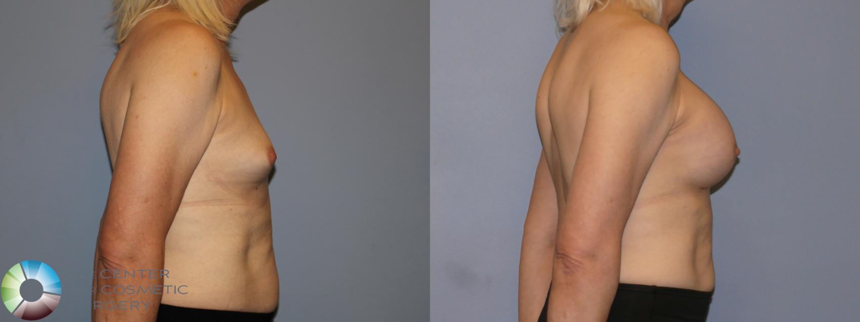 Before & After MTF Top Surgery/Breast Augmentation Case 12115 Right Side in Denver and Colorado Springs, CO
