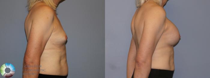 Before & After MTF Top Surgery/Breast Augmentation Case 12115 Right Side in Denver and Colorado Springs, CO