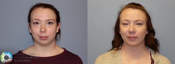 Before & After Mini Facelift Case 11237 Front in Denver and Colorado Springs, CO