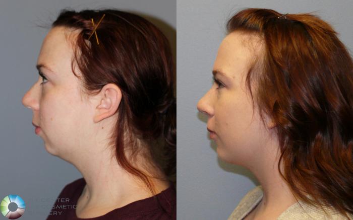 Before & After Mini Facelift Case 11237 Left Side in Denver and Colorado Springs, CO