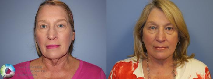 Before & After Neck Lift Case 11487 Front View in Golden, CO