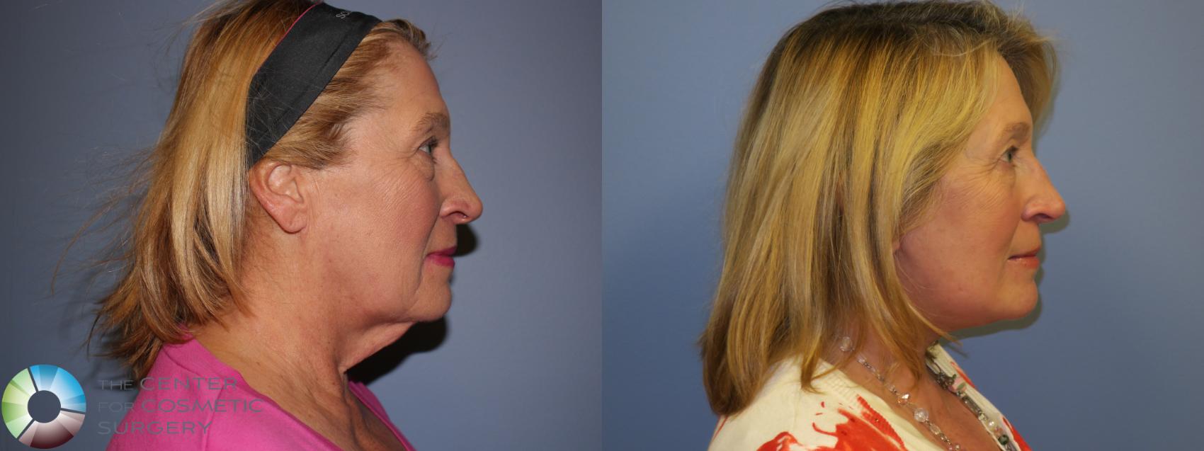 Before & After Neck Lift Case 11487 Right Side View in Golden, CO