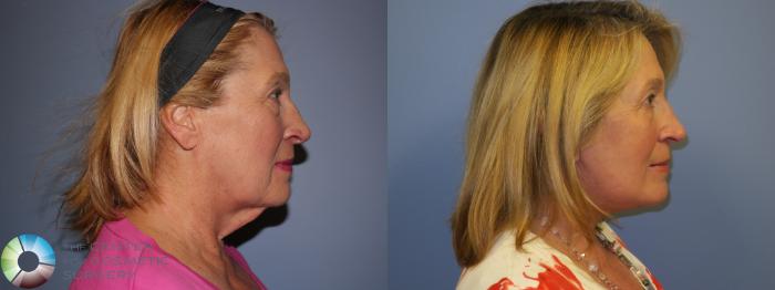 Before & After Neck Lift Case 11487 Right Side View in Golden, CO
