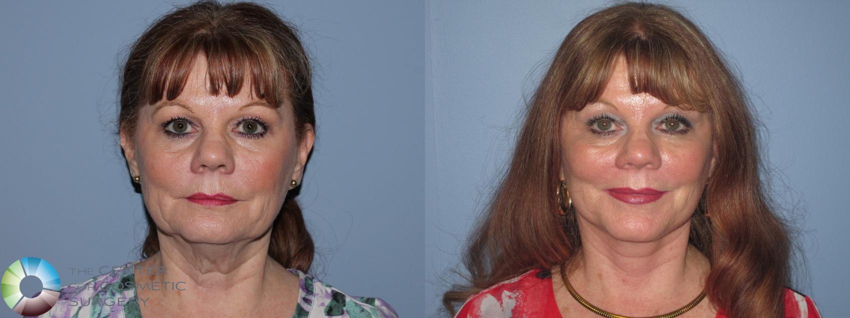 Before & After Neck Lift Case 11490 Front View in Golden, CO