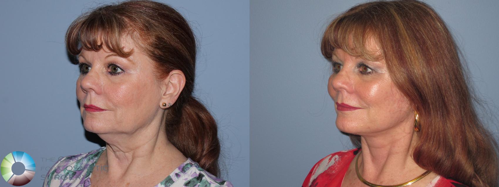 Before & After Neck Lift Case 11490 Left Oblique View in Golden, CO
