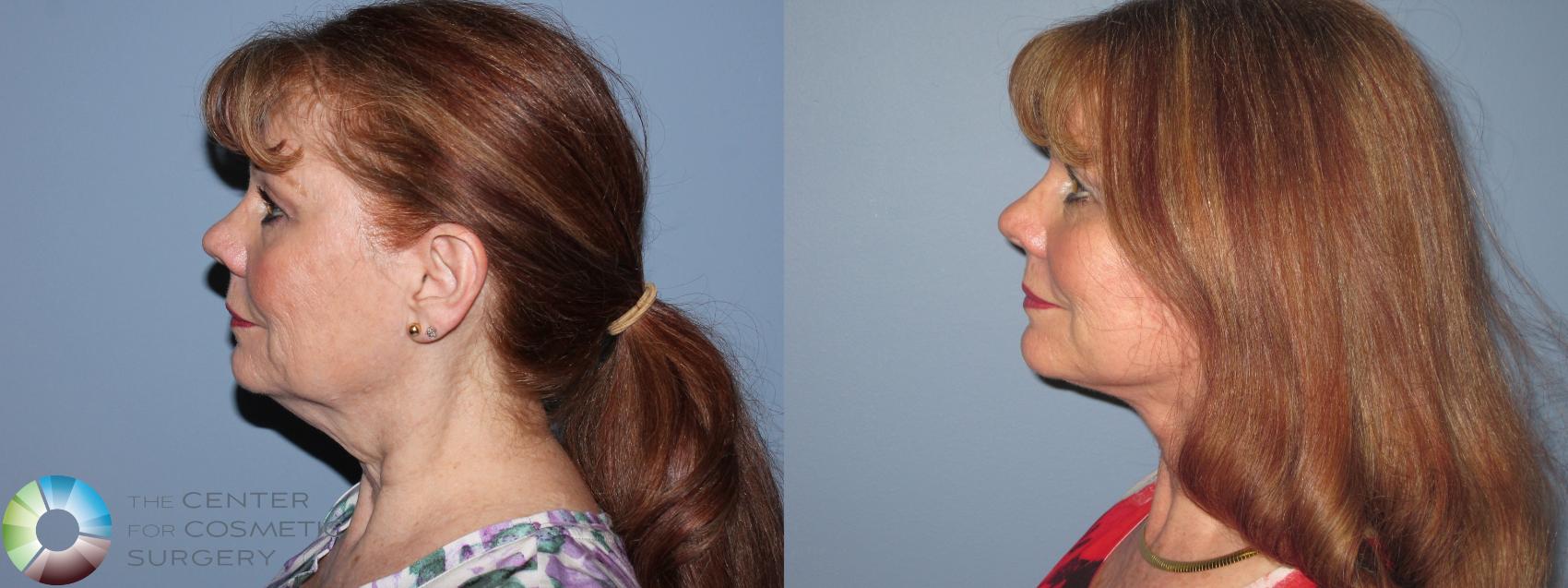 Before & After Neck Lift Case 11490 Left Side View in Golden, CO