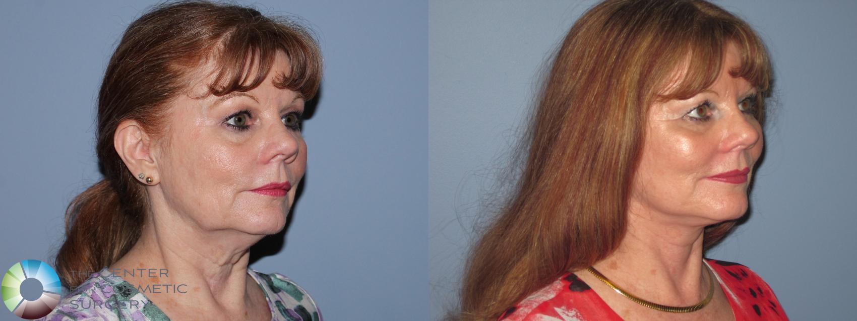 Before & After Neck Lift Case 11490 Right Oblique View in Golden, CO