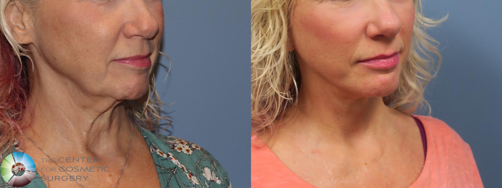 Before & After Neck Lift Case 11740 Right Oblique in Denver and Colorado Springs, CO