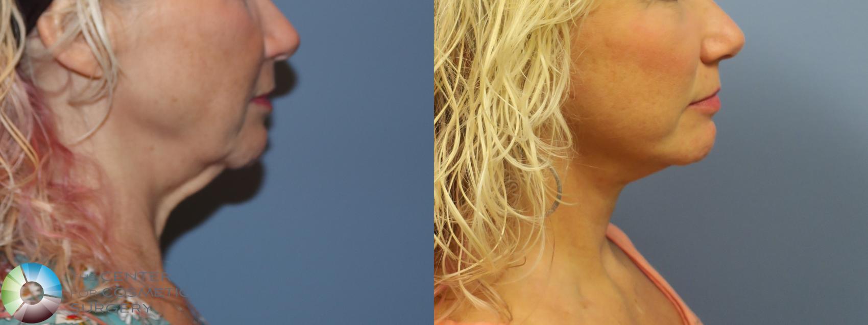 Before & After Neck Lift Case 11740 Right Side in Denver and Colorado Springs, CO