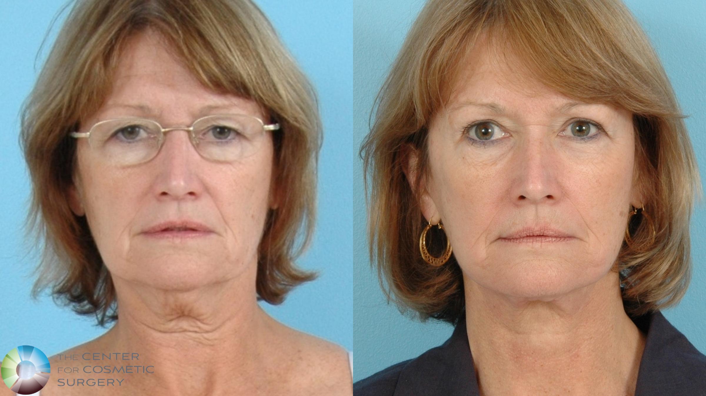 Before & After Neck Lift Case 11844 Front View in Golden, CO