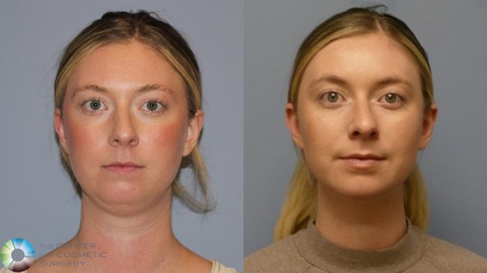 Before & After Neck Lift Case 11921 Front in Denver and Colorado Springs, CO